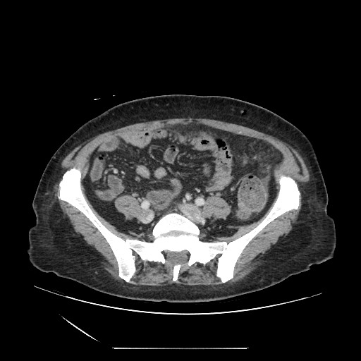 Acinar cell carcinoma of the pancreas (Radiopaedia 75442-86669 Axial C+ portal venous phase 103).jpg