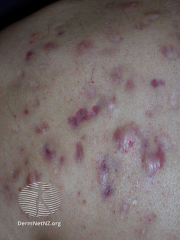 File:Acne affecting the back images (DermNet NZ acne-acne-back-192).jpg