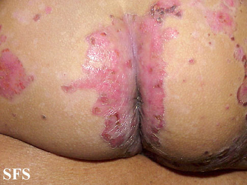 File:Acrodermatitis Enteropathica (Dermatology Atlas 19).jpg