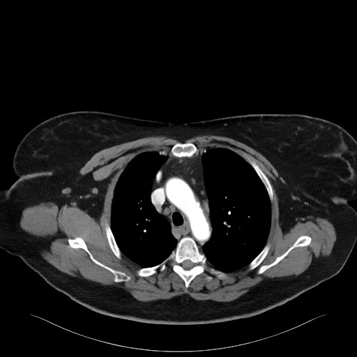 Acromioclavicular joint cyst (Radiopaedia 58455-65610 Axial C+ arterial phase 41).jpg