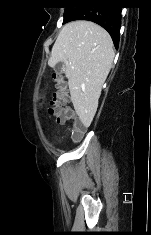 Active Crohn disease (Radiopaedia 59394-66750 Sagittal C+ portal venous phase 48).jpg