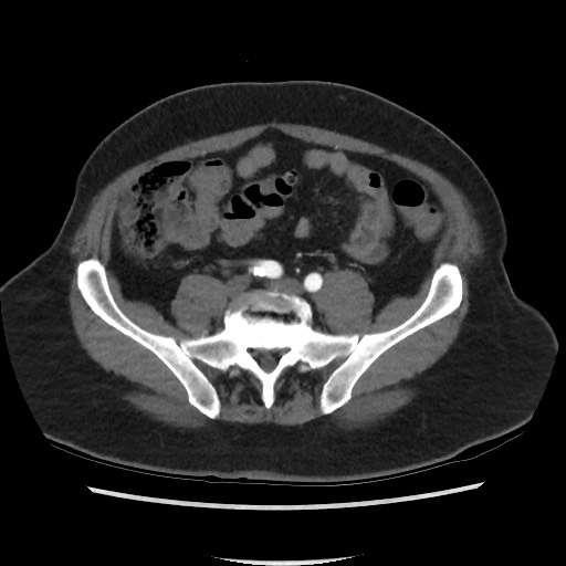 Active colonic bleed on CT (Radiopaedia 49765-55025 Axial C+ arterial phase 58).jpg