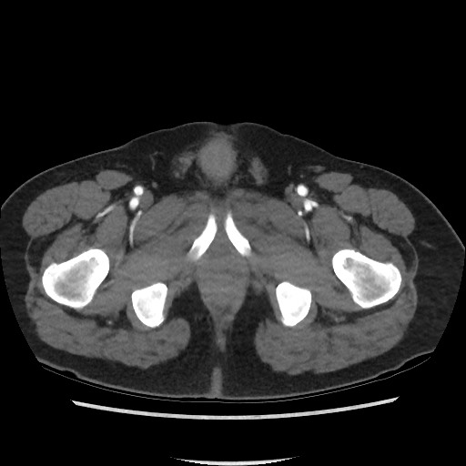 Active colonic bleed on CT (Radiopaedia 49765-55025 Axial C+ arterial phase 87).jpg