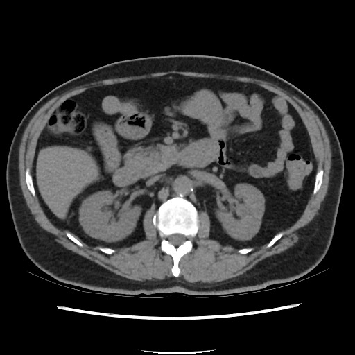 Active colonic bleed on CT (Radiopaedia 49765-55025 Axial non-contrast 31).jpg
