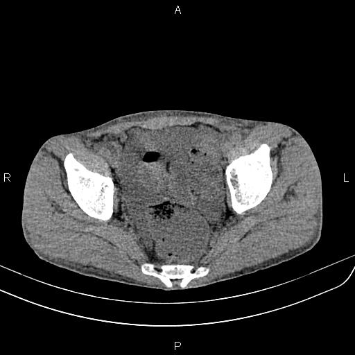Active crohn disease (Radiopaedia 87133-103397 Axial non-contrast 90).jpg