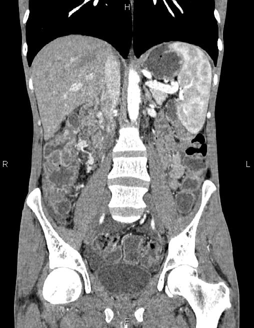 Active crohn disease (Radiopaedia 87133-103397 Coronal C+ arterial phase 36).jpg