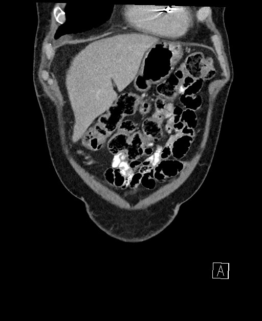 Active lower gastrointestinal bleeding - diverticular (Radiopaedia 61203-69106 Coronal C+ portal venous phase 25).jpg