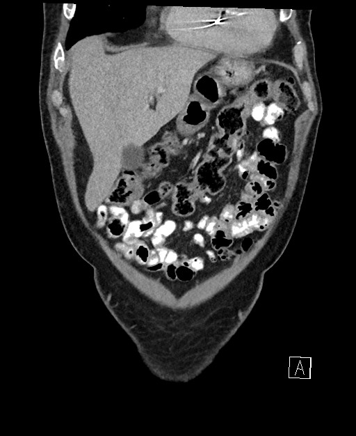 Active lower gastrointestinal bleeding - diverticular (Radiopaedia 61203-69106 Coronal C+ portal venous phase 31).jpg