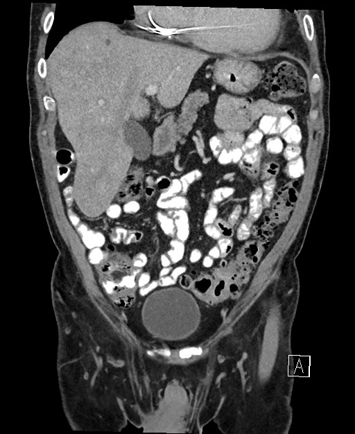 Active lower gastrointestinal bleeding - diverticular (Radiopaedia 61203-69106 Coronal C+ portal venous phase 47).jpg