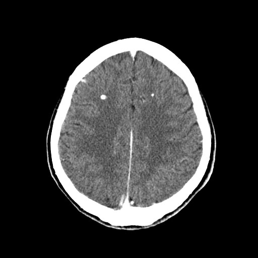 File:Active neurocysticercosis before and after therapy (Radiopaedia 71710-82100 Axial C+ delayed 68).jpg