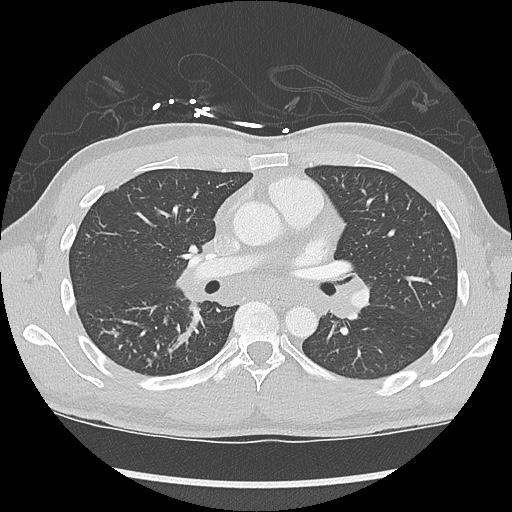 File:Active right ventricular cardiac sarcoidosis (Radiopaedia 55596-62101 Axial lung window 20).jpg
