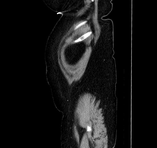 Acute appendicitis, heterotaxy syndrome (Radiopaedia 66884-76202 Sagittal C+ portal venous phase 20).jpg