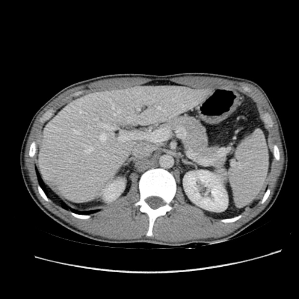 Acute appendicitis (Radiopaedia 27049-27227 Axial C+ portal venous phase 19).jpg