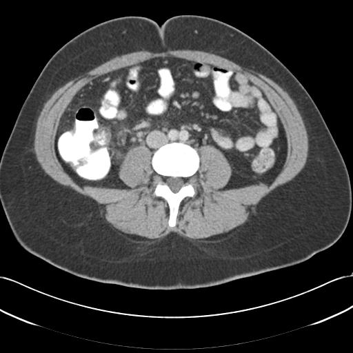 Acute appendicitis (Radiopaedia 30297-30934 Axial C+ portal venous phase 47).jpg