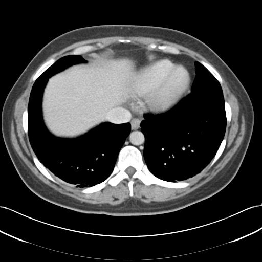 File:Acute appendicitis (Radiopaedia 30297-30934 Axial C+ portal venous phase 7).jpg