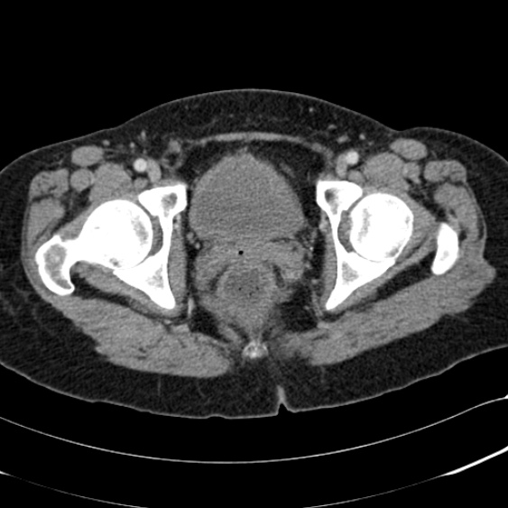 Acute appendicitis (Radiopaedia 48792-53822 Axial C+ portal venous phase 114).jpg