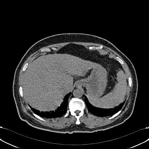 Acute appendicitis (Radiopaedia 58627-65818 Axial non-contrast 18).jpg