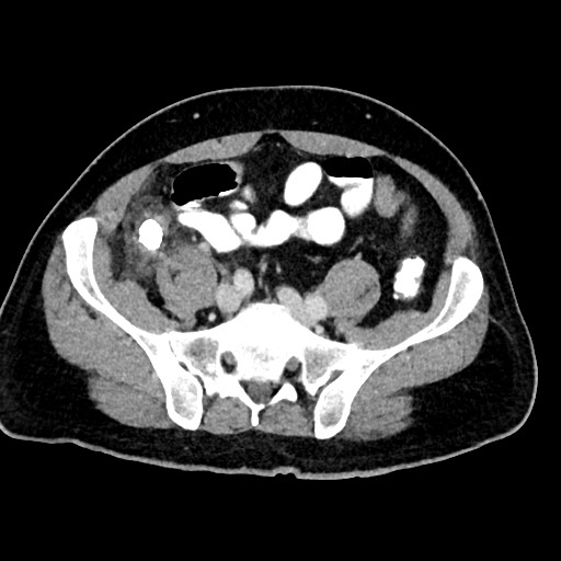 Acute appendicitis (Radiopaedia 77016-88960 Axial C+ portal venous phase 104).jpg