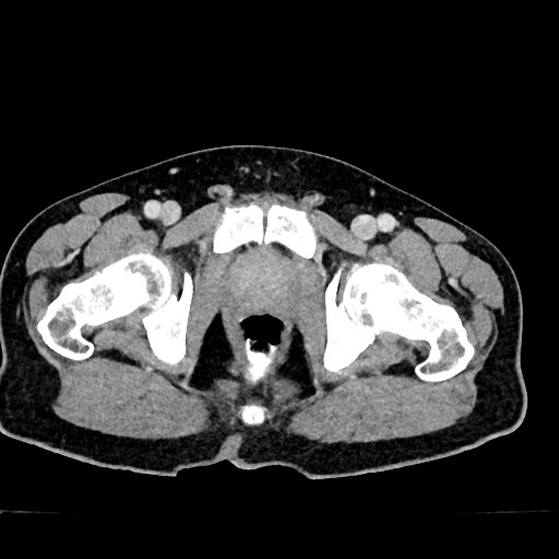 Acute appendicitis (Radiopaedia 77016-88960 Axial C+ portal venous phase 142).jpg