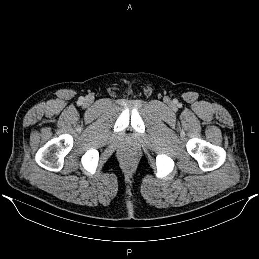 Acute appendicitis (Radiopaedia 84780-100240 Axial C+ portal venous phase 115).jpg