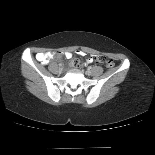 File:Acute appendicitis (Radiopaedia 9417-10099 Axial C+ portal venous phase 3).jpg