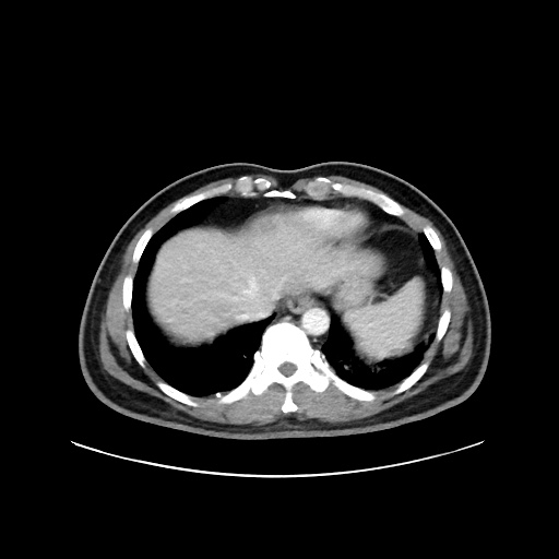 Acute appendicitis and COVID 19 pneumonia (Radiopaedia 76604-88380 Axial C+ portal venous phase 8).jpg