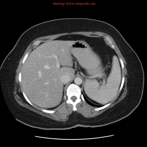 Acute appendicitis complicated by ovarian vein thrombophlebitis (Radiopaedia 16172-15851 Axial C+ portal venous phase 23).jpg