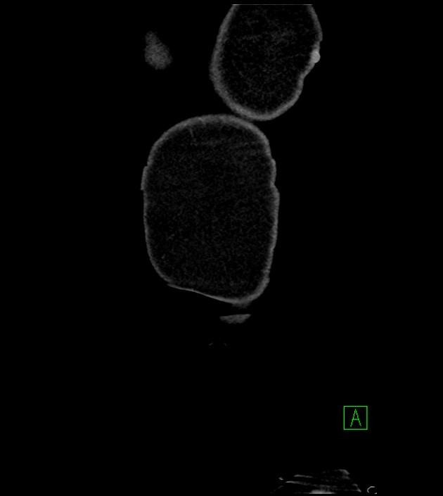 Acute arterial mesenteric ischemia (Radiopaedia 78238-90828 Coronal C+ portal venous phase 6).jpg