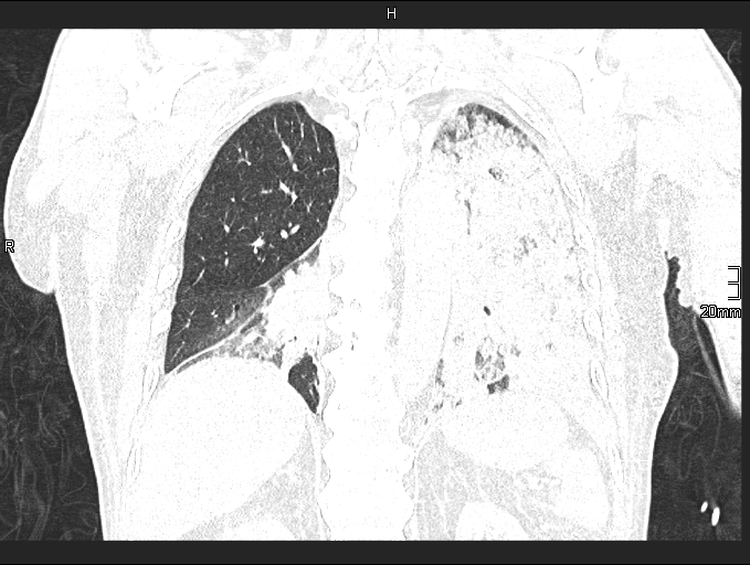 Acute aspiration pneumonitis (Radiopaedia 55642-62166 Coronal lung window 72).jpg