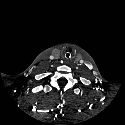 Acute basilar artery occlusion (Radiopaedia 43582-46985 Axial C+ arterial phase 259).jpg