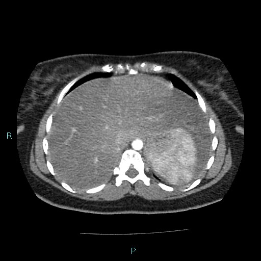 Acute bilateral pyelonephritis (Radiopaedia 37146-38881 Axial C+ arterial phase 20).jpg