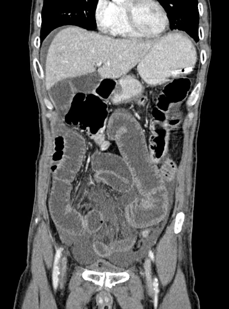 Acute bowel ischemia (Radiopaedia 87695-104114 Coronal C+ portal venous phase 146).jpg