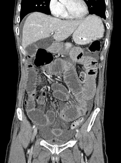 Acute bowel ischemia (Radiopaedia 87695-104114 Coronal C+ portal venous phase 160).jpg