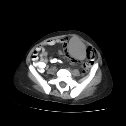 File:Acute calculous cholecystitis in patient with osteopetrosis (Radiopaedia 77871-90159 Axial non-contrast 58).jpg