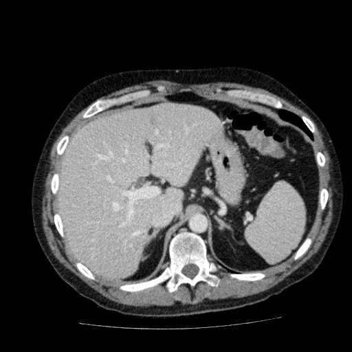 Acute cholecystitis and incidental left sided IVC (Radiopaedia 49352-54459 Axial C+ portal venous phase 42).jpg