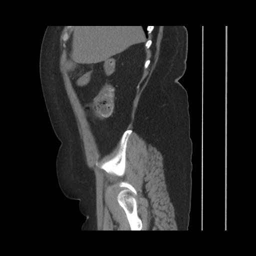Acute cholecystitis with tensile fundus sign (Radiopaedia 71394-81723 Sagittal non-contrast 49).jpg