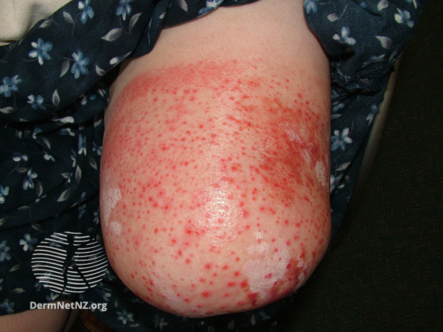 File:Acute dermatitis affecting amputation stump (DermNet NZ reactions-amputation-stump-06).jpg