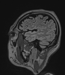 File:Acute disseminated encephalomyelitis (ADEM)- Anti-NMDA receptor encephalitis (Radiopaedia 54920-61201 Sagittal FLAIR 22).png