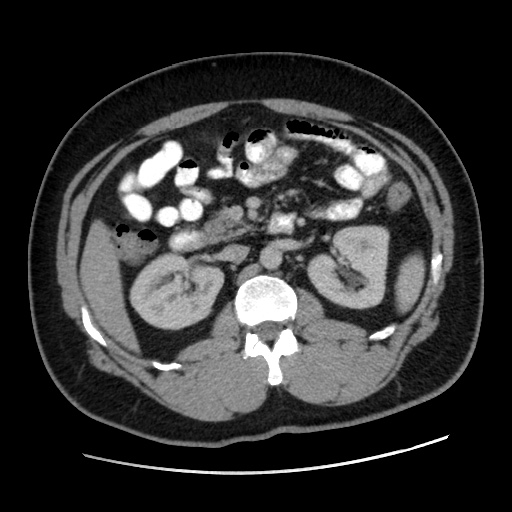 Acute diverticulitis with localized perforation (Radiopaedia 41296-44113 Axial C+ portal venous phase 37).jpg
