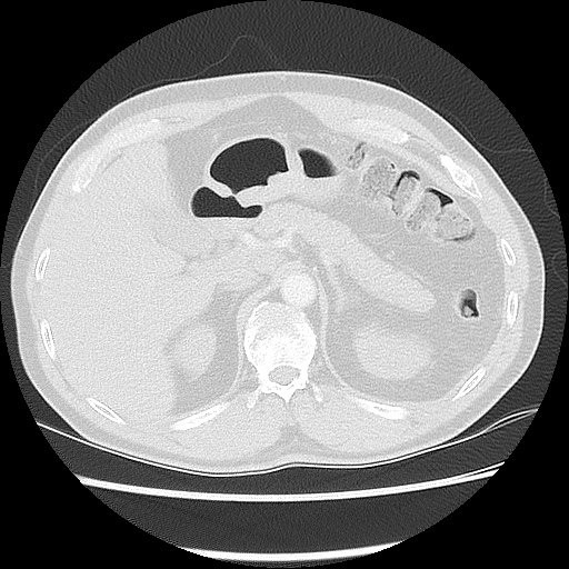 Acute epicardial fat necrosis (Radiopaedia 42327-45440 Axial lung window 56).jpg