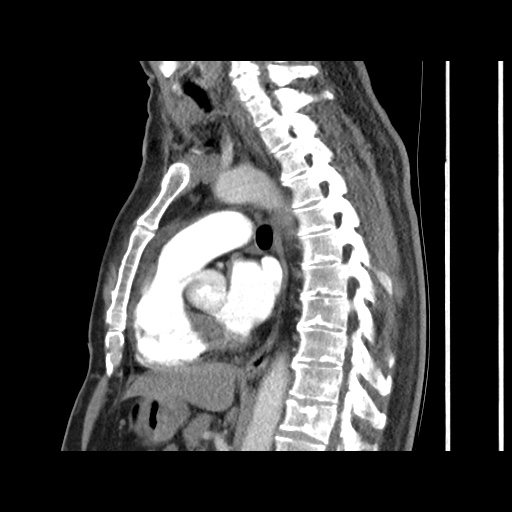 Acute epicardial fat necrosis (Radiopaedia 42327-45440 Sagittal C+ CTPA 40).jpg