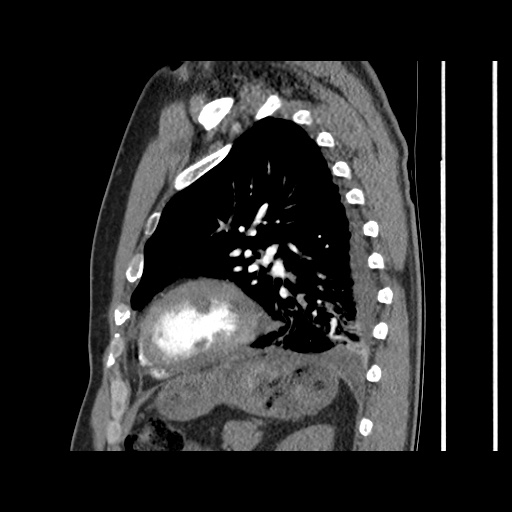 Acute epicardial fat necrosis (Radiopaedia 42327-45440 Sagittal C+ CTPA 50).jpg