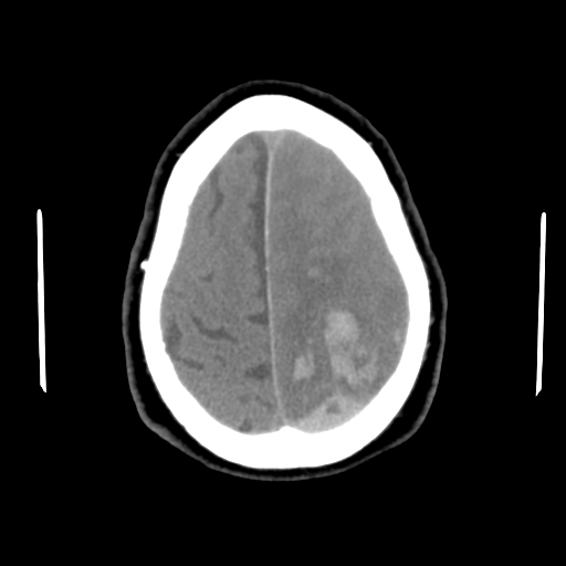File:Acute hemorrhagic stroke (Radiopaedia 17507-17223 Axial non-contrast 43).jpg