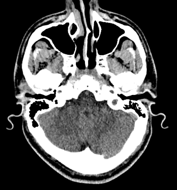 Acute ischemic stroke - posterior circulation territory (Radiopaedia 77670-89881 non-contrast 16).jpg