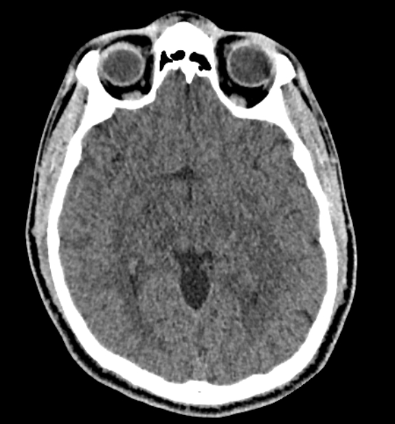 Acute ischemic stroke - posterior circulation territory (Radiopaedia 77670-89881 non-contrast 40).jpg