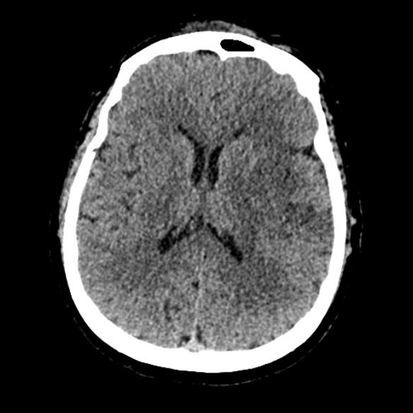 Acute middle cerebral artery territory infarct (Radiopaedia 52380-58283 Axial non-contrast 59).jpg