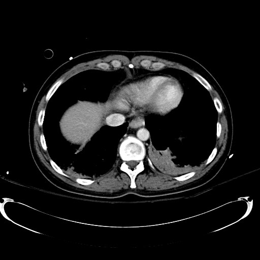 Acute myocardial infarction in CT (Radiopaedia 39947-42415 Axial C+ portal venous phase 14).jpg