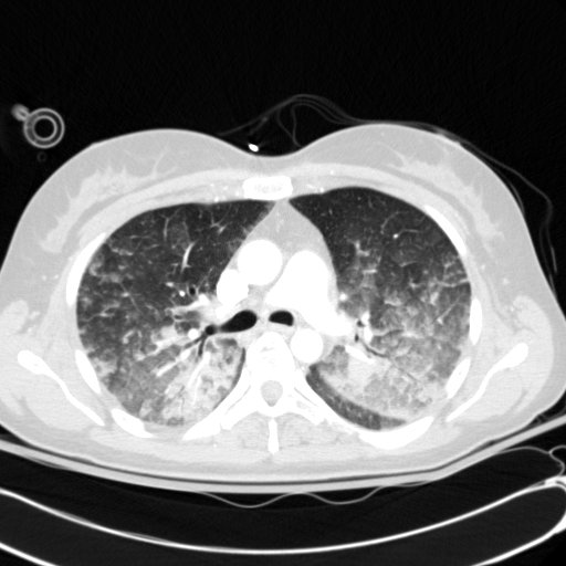 File:Acute myocardial infarction in CT (Radiopaedia 39947-42415 Axial lung window 47).jpg