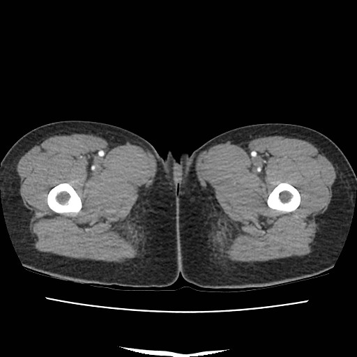 Acute myocarditis (Radiopaedia 55988-62613 Axial C+ portal venous phase 93).jpg