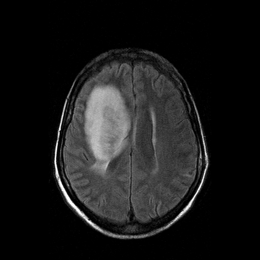 File:Acute necrotizing toxoplasma encephalitis (Radiopaedia 10683-11149 Axial FLAIR 6).jpg